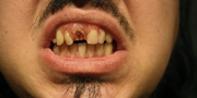 Dentures