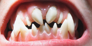 Dentures